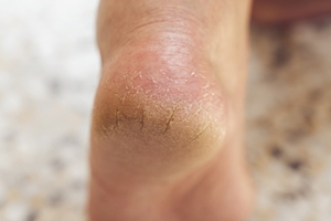 Causes and Risk Factors of Cracked Heels