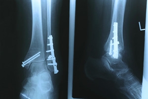 What Are Stress Fractures?