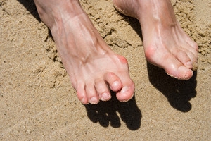 Hammertoe and Shoes