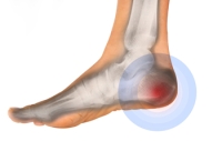 When Heel Pain Is Caused by Plantar Fasciitis