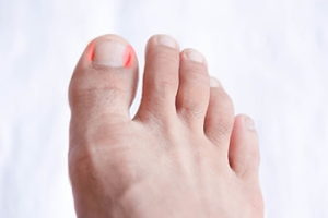 Avoid Developing an Ingrown Toenail