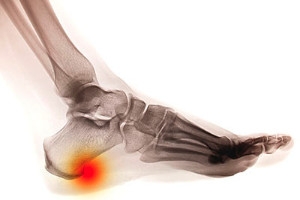 What Causes Plantar Fasciitis?