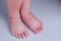 Causes of Foot and Ankle Swelling