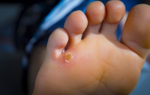 Development of Foot Corns and Calluses